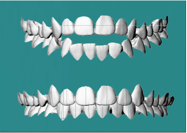 DENTI APERTI